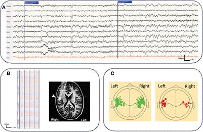 Functional and Structural Network Disorganizations in Typical Epilepsy With Centro-Temporal Spikes and Impact on Cognitive Neurodevelopment